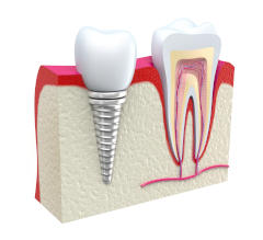 implanty stomatologiczne rzeszów